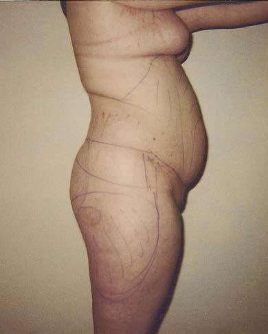 Abdomen hips & buttocks Medial