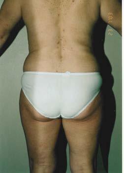 Liposuction can be Therapeutic The removal of large