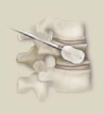 compression fractures (VCFs) by reducing and stabilizing the fracture.