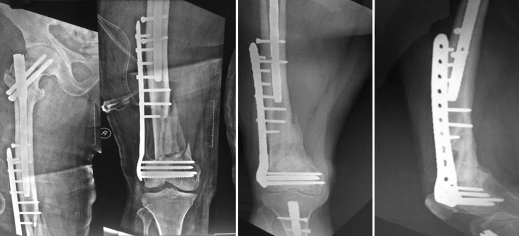 Ll, et l.: Role of LCP in distl femur frctures Figure 6: Cse 2 - () Immedite post-opertive. () Post-opertive fter 6 months nd functionl outcome ws ssessed using Oxford Knee Score.