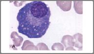 Hallmarks of MM Lytic lesions, Pathologic fractures, Hypercalcemia Anemia Plasma cell Bone destruction Marrow infiltration MULTIPLE MYELOMA Monoclonal