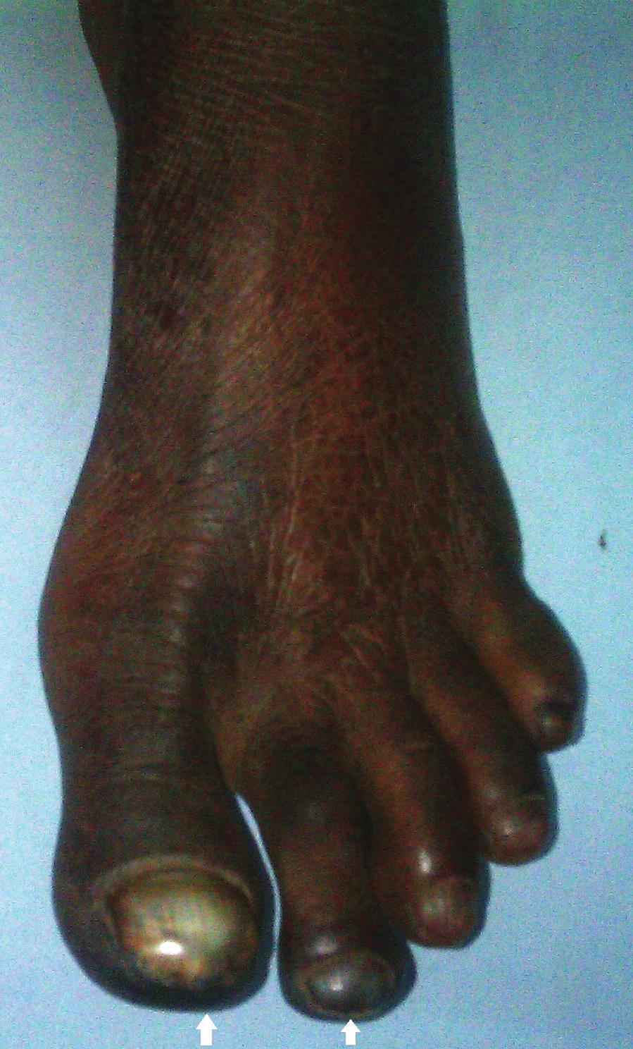 2 Figure 1: Left foot of the patient. The arrows depict gangrene of the 1st and 2nd toes. Also note the cyanosis of the rest of toes and ischemic changes on the skin of the foot.