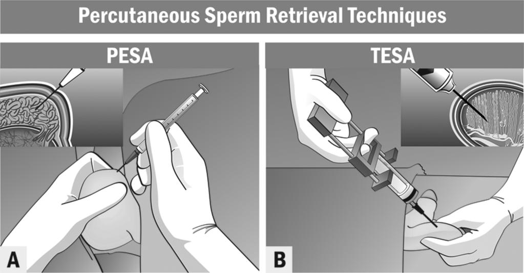 Step-by-step description of surgical techniques Percutaneous sperm retrieval techniques Anesthesia Percutaneous sperm retrieval is carried out under local anesthesia only or in association with