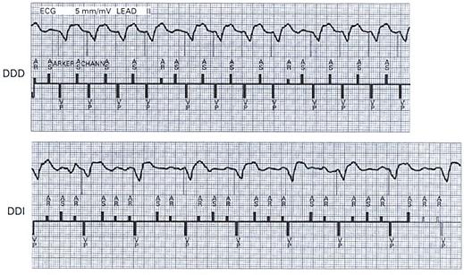 syncope Atrial fibrillation pre and post mode switching