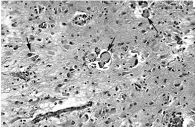 Krabbe Disease Globoid Cell Leukodystrophy Autosomal recessive Galactocerebrosidase deficiency GALC needed for the production of normal