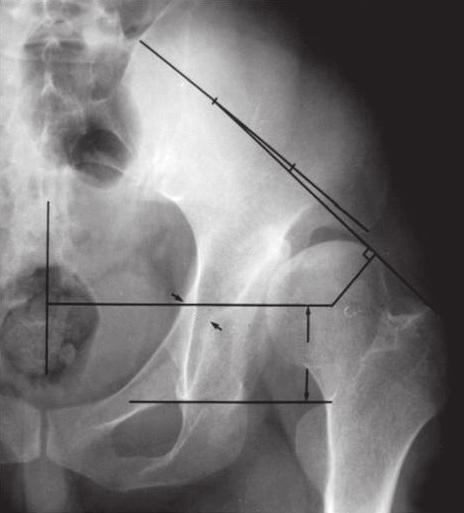 METHODS Materials This study involved 38 patients (38 hips) who were available for a minimum 3-year follow-up after THA with circumferential osteotomy of the medial acetabular wall.