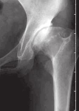 osteotomy was used in THA to obtain adequate coverage of the acetabular component and a natural center of