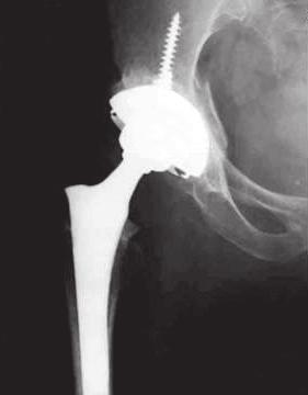 (c) Anteroposterior radiograph, taken 11 years postoperatively, showing thick bone stock of the well remodeled