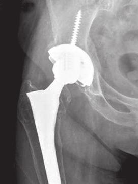 (B) Preoperative (a) and 6-month postoperative (b) radiographs in a 21-yearold woman's hip in which a medial wall
