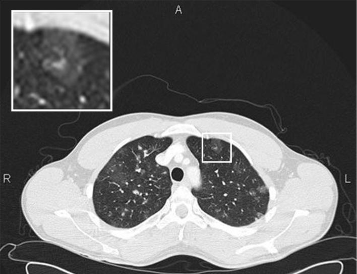 Figure 5: 28 y old male with pulmonary schistosomiasis.