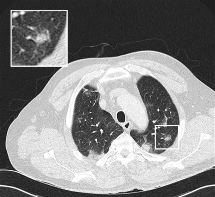 Chest CT of the upper lungs showing blurred ground glass nodules scattered over both lungs (Siemens Sensation 16. 120 kv, 100 mas, 16x1.