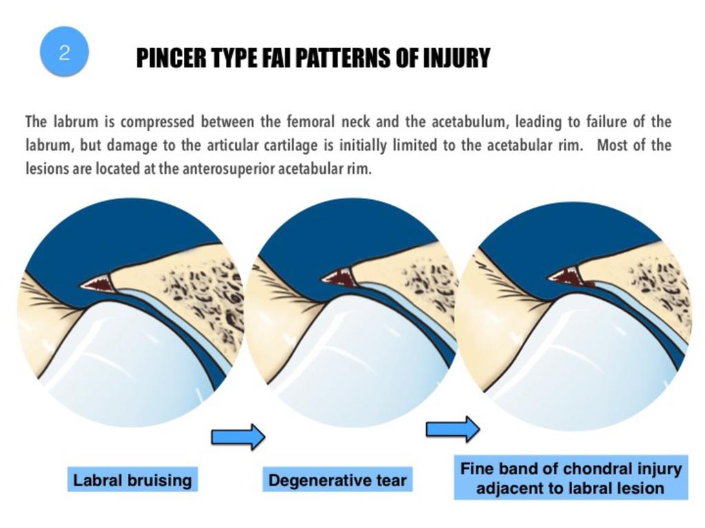 Fig. 13: Progressive patterns of articular injury in pincer-type FAI. The main articular injury in pincer FAI consists in labral degenerative tears.
