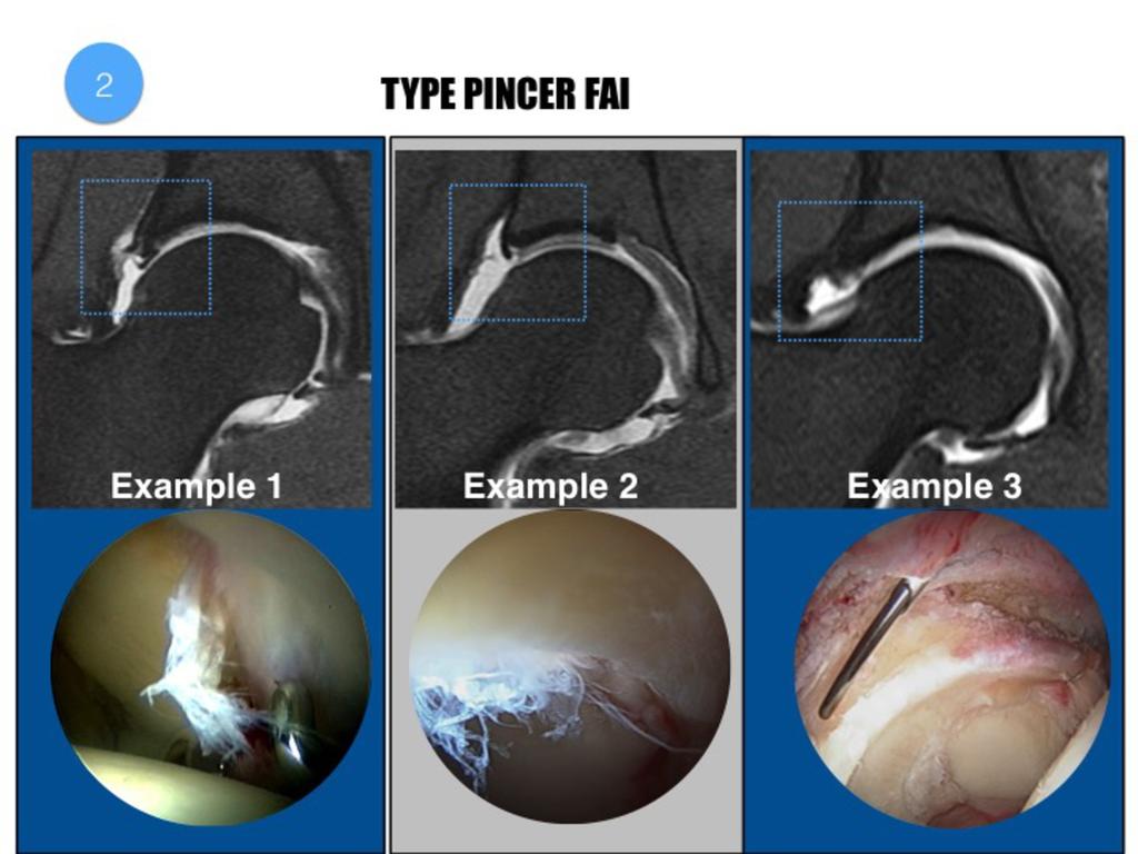 Fig. 14: Three different examples of pincer type FAI.