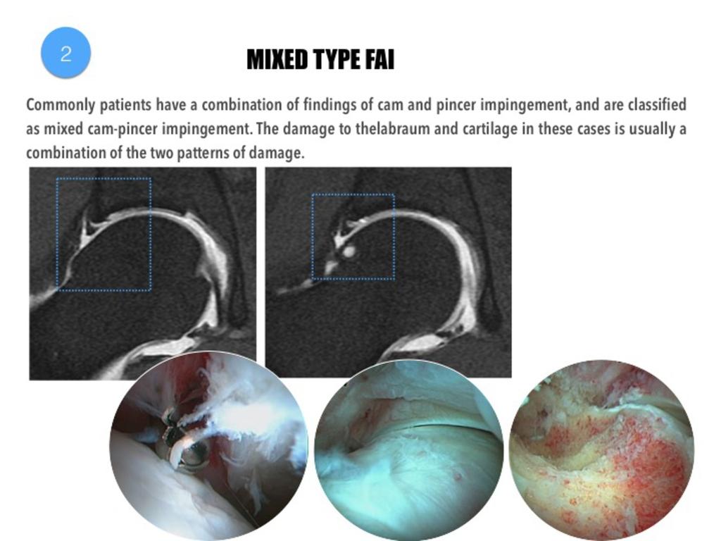 Fig. 16: Mixed type of FAI. Consecutive MR arthrography images demonstrate a combination of findings of cam and pincer impingement.