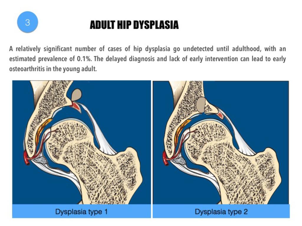 Fig. 17: Adult hip displasia.