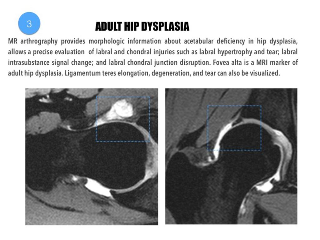 Fig. 18: Adult hip dysplasia in a 32 year-old woman.