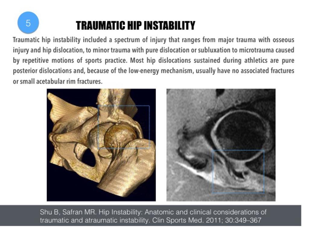 Fig. 23: On the left, we can see an example of traumatic dislocation in a rugby player. 3D CT image shows a large posterior wall fracture.