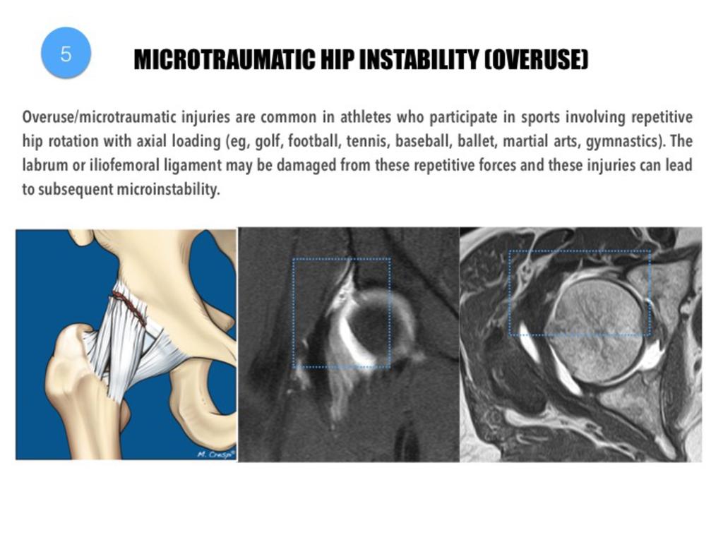Fig. 24: Overuse instability in a 26-year old soccer player.