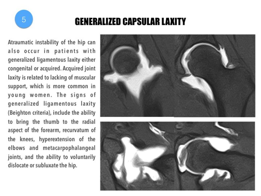 Fig. 25: 22-year old woman with generalized ligamentous laxity.