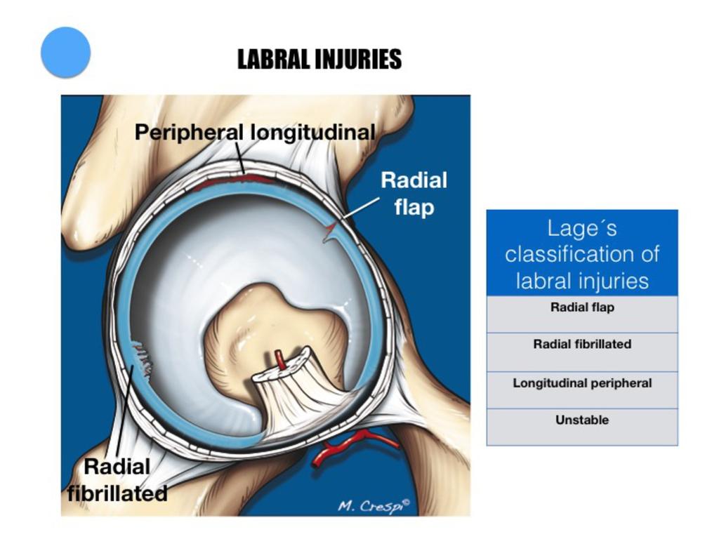 Fig. 29: Lage s classification, which is the most commonly arthroscopic classification system used for hip labral tears.