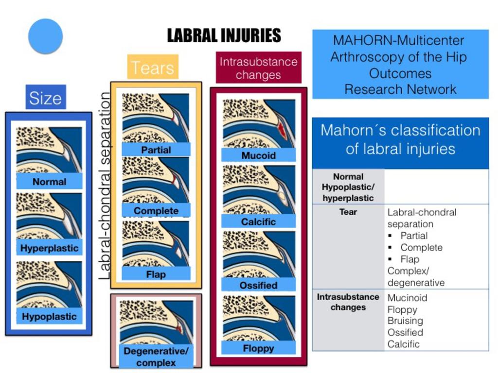 Fig. 30: Mahorn (Multicenter Arthroscopy of the Hip Outcomes Research Network) classification system of labral