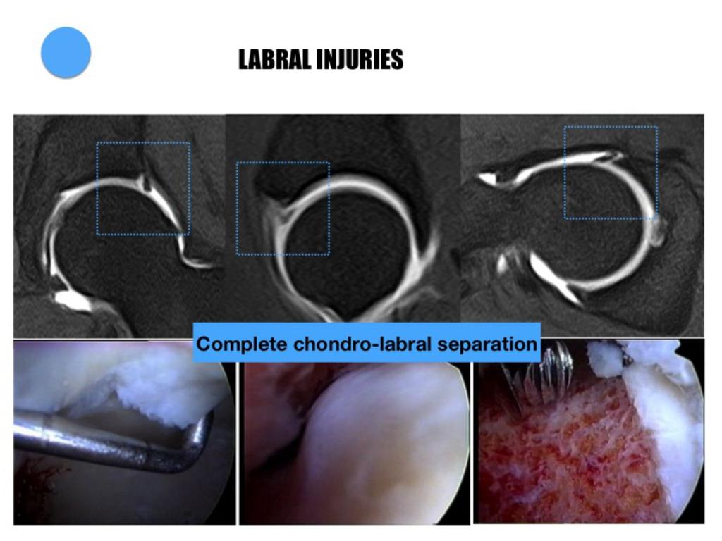 Fig. 32: Complete chondro-labral separation in a patient with cam type FAI.