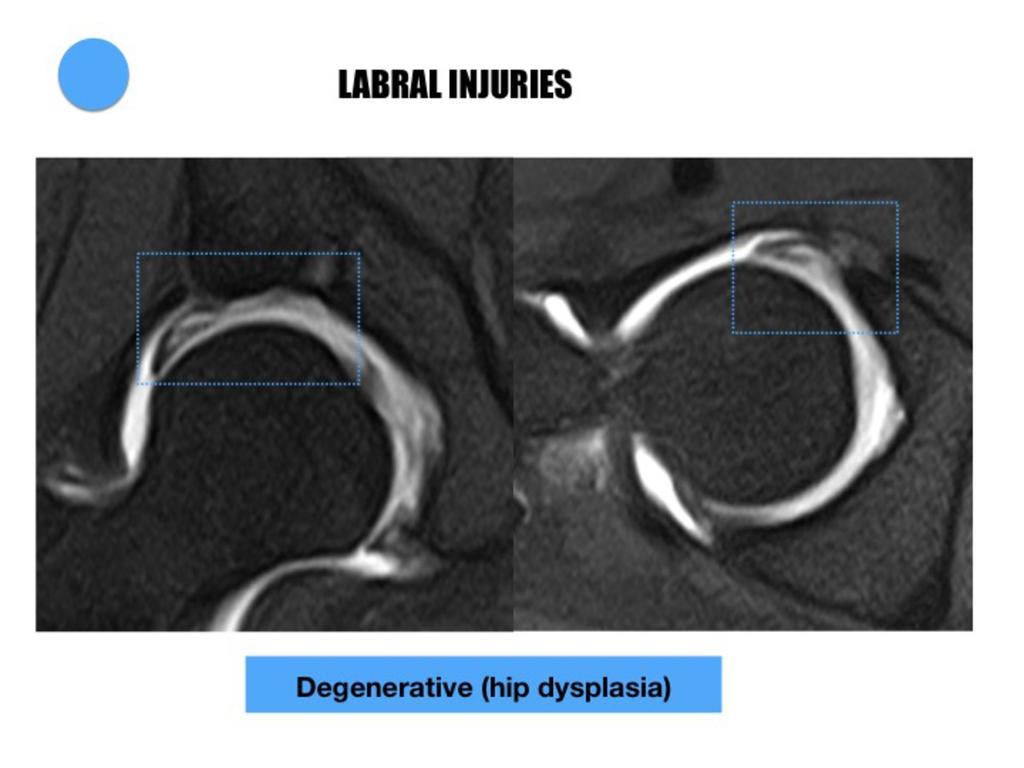 Fig. 36: Hyperplastic labrum in a patient with adult hip dysplasia with