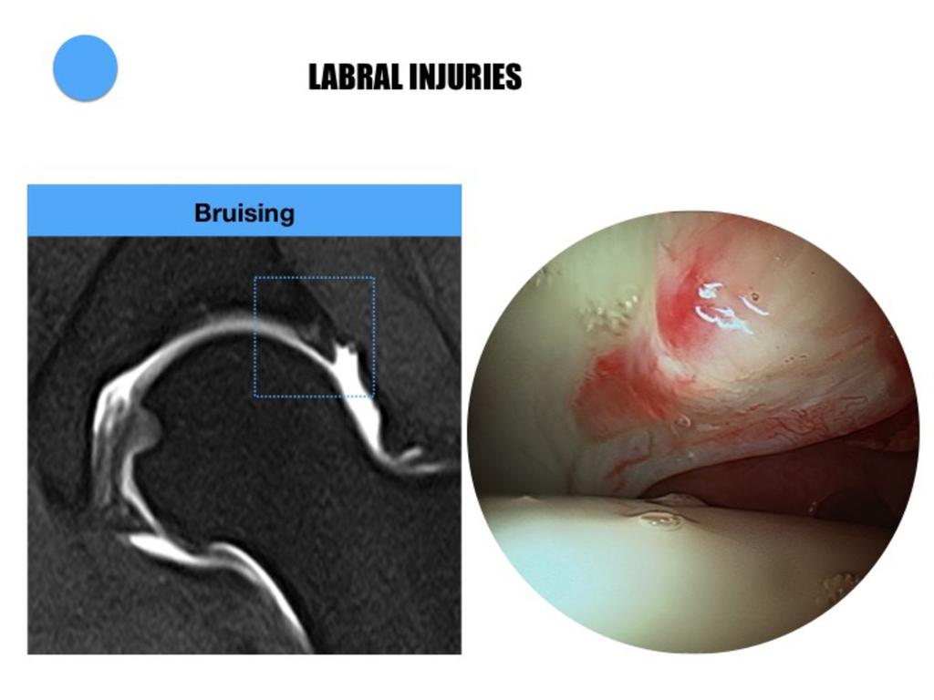 Fig. 37: Coronal MR arthrogram image showing intrasubstancial changes on the medial side of the labrum.