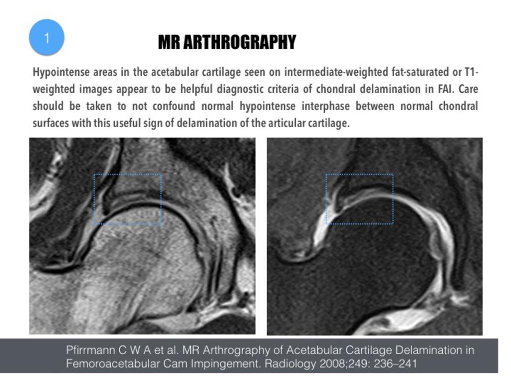 Fig. 2: Coronal T1-weighted, and T1-fat suppressed images show hypointense areas in the