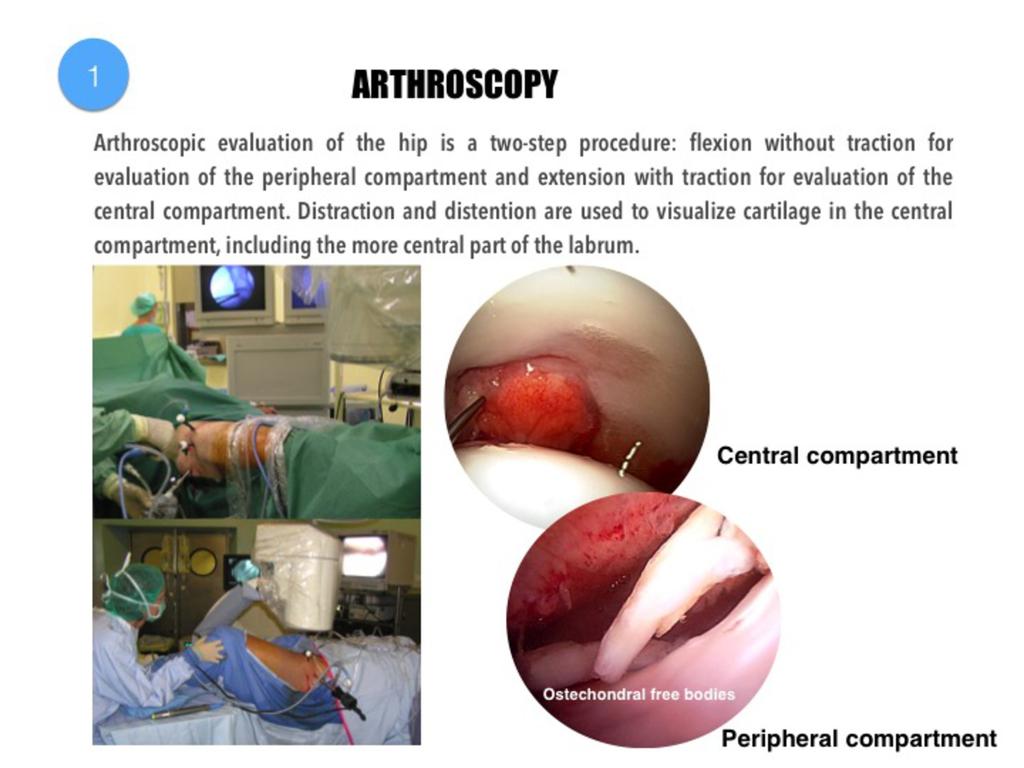 Fig. 3: Arthroscopic evaluation of the hip is a two-step procedure: flexion without traction for evaluation of