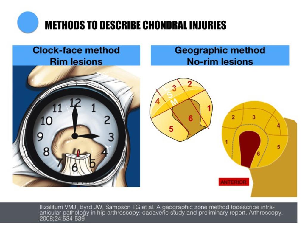 Fig. 48: The reporting of geographic location of labral and chondral injuries is facilitated with the geographic method (no rim lesions) and clock-face system (rim lesions).