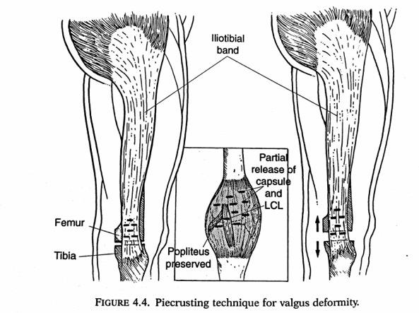 SOFT TISSUE RELEASES OUR PHYLOSOPHY USUALLY WITH FIXED- VALGUS FURTHER PIECRUSTING RELEASE OF ILEOTIBIAL