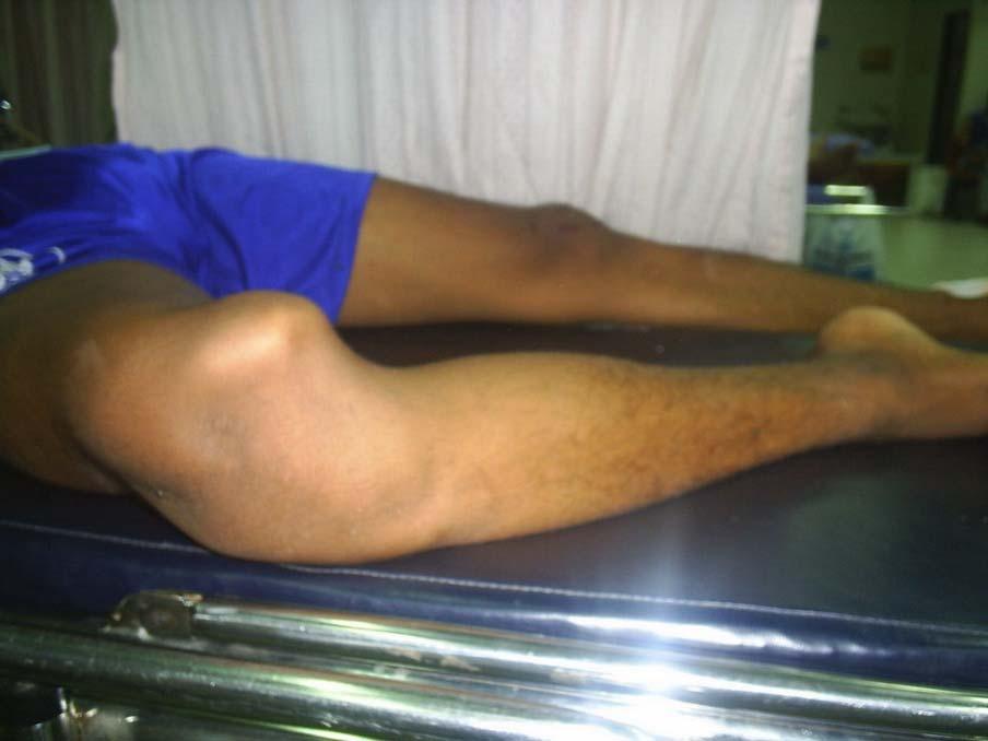 High-Energy Knee Dislocations Usually MVA or fall from a height Dashboard injury common Forced Hyperextension