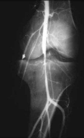 Complications Arthrofibrosis (38%) Recurrent laxity and
