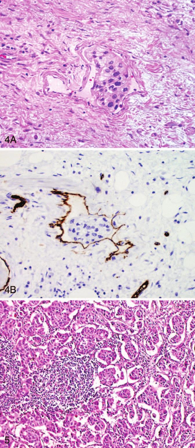 Figure 4. A, Lymphovascular space is characteristic of endothelial lining and blood cellular components (hematoxylin-eosin, original magnification 200).