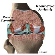 A Patient's Guide to Rheumatoid Arthritis Introduction Rheumatoid arthritis (RA) is a chronic, or long-term, inflammatory form of arthritis.