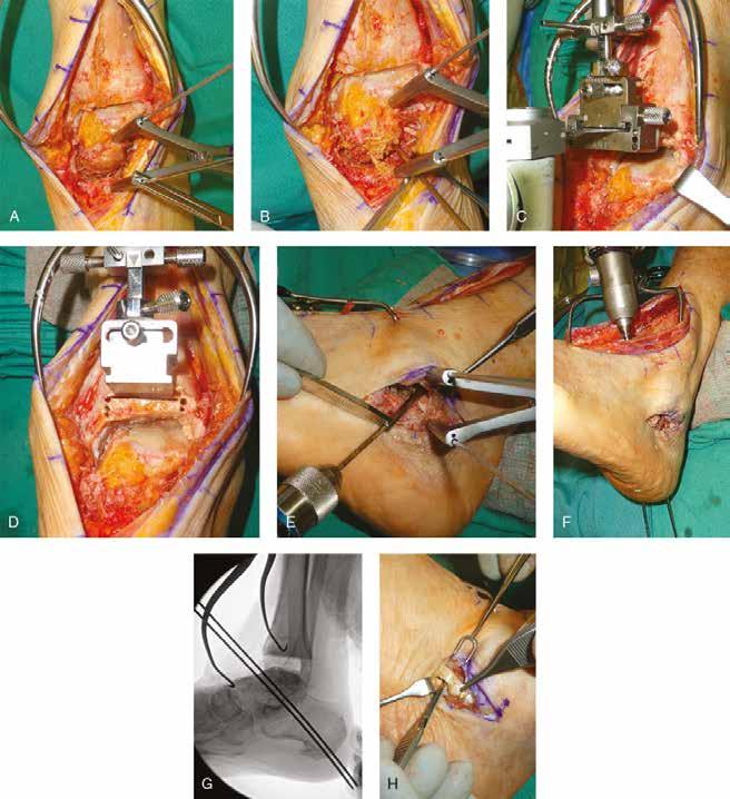 Degenerative Conditions of the Ankle Figure 7 Intraoperative photographs of the same patient shown in Figure 6 show exposure of the talonavicular joint by distal extension of the anterior ankle