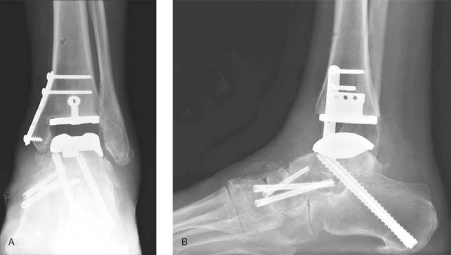 Alignment in Total Ankle Arthroplasty With Coronal Plane Deformity: Bony and Ligamentous Figure 8 Follow-up radiographs of the same patient shown in Figures 6 and 7.