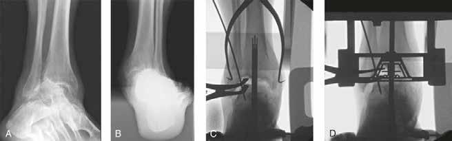 Alignment in Total Ankle Arthroplasty With Coronal Plane Deformity: Bony and Ligamentous Figure 1 Severe valgus ankle arthritis is shown in a preoperative weight-bearing oblique ankle radiograph