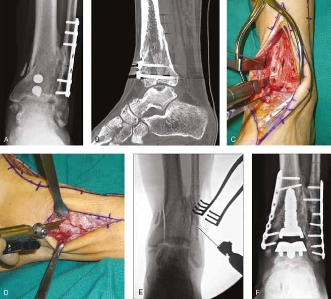 Degenerative Conditions of the Ankle Figure 4 A, Preoperative weight-bearing AP radiograph demonstrates left distal tibial varus malunion and ankle arthritis in a 65-year-old man with severe ankle