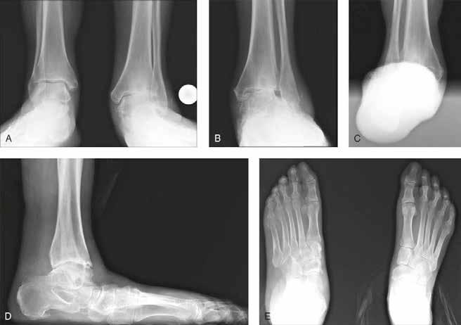 Alignment in Total Ankle Arthroplasty With Coronal Plane Deformity: Bony and Ligamentous Figure 6 A, Bilateral AP weight-bearing ankle radiographs demonstrate left valgus ankle arthritis associated
