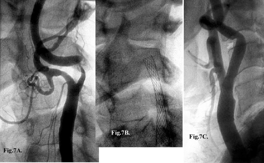 Kinking of distal ICA after CAS Fig.7A. 90% left internal carotid artery stenosis within the vessel kink., 7B. Wallstent 10 x20, 7C. Post CAS.