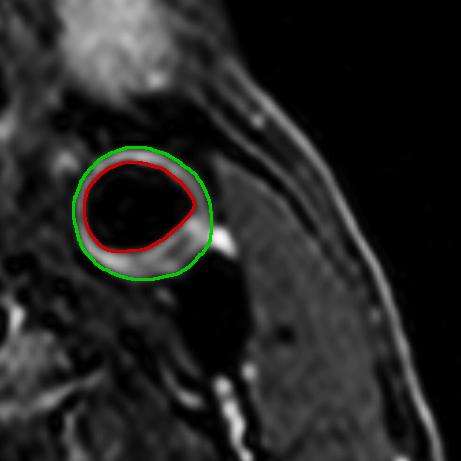 Methods: Carotid MRI 1.5 or 3T MRI system T2-weighted, black-blood, turbo spine echo (TSE) sequence 3 mm slice thickness, 0.3 mm x 0.