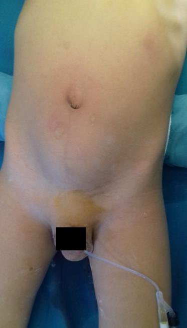 Kerkeni et al.: A Rare Cause of Recurrent Vaginal Hydrocele Case report A 5-yr-old boy was admitted to the Pediatric Surgery Department of our Children s Hospital in Tunis on Sep 2015.
