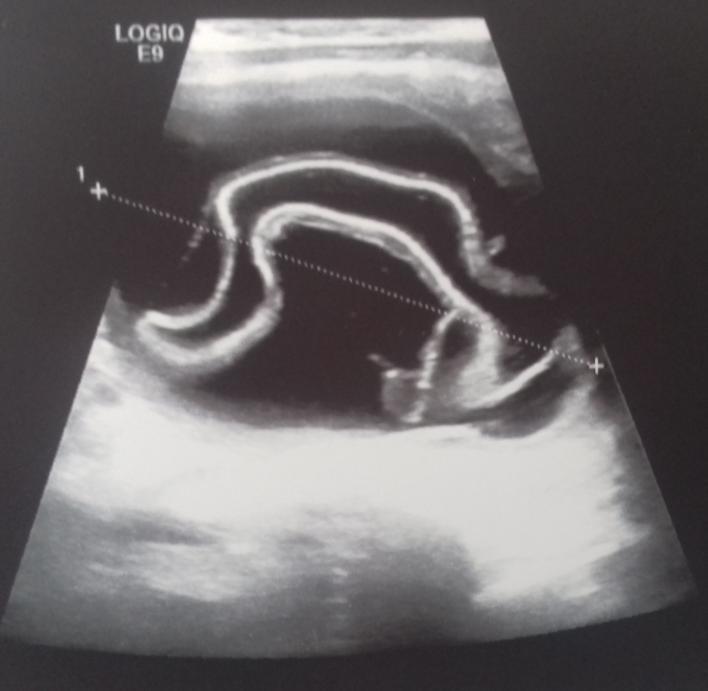 On examination, a mass approximately 6 8, 5 cm in diameter was identified in hypogastric region. External genitalia examination was suggestive of recurrent communicating left vaginal hydrocele (Fig.
