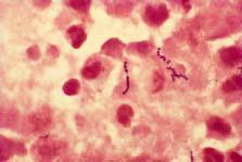 Laboratory Diagnosis: Group A Streptococcus Grams stained wound