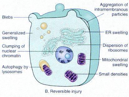 Patterns of Acute Cell Injury Reversible Injury Cellular swelling: Ultrastructural changes plasma membrane blebbing, blunting and distortion of microvilli mitochondrial swelling,