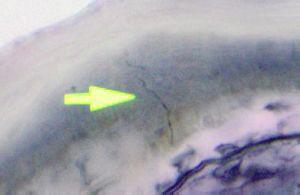 SKIN, LEFT CALF, PUNCH BIOPSY: Intra-epidermal nerve fiber density is borderline low (7.97 Fibers/mm). Papillary dermal nerve fibers atretic and slightly diminished. ( See Comment 2). B. SKIN, LEFT CALF, PUNCH BIOPSY: Intra-epidermal nerve counts in normative range (13.