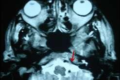 Only the sigmoid sinus is seen