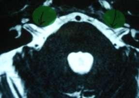 Axial T2 3D BFFE MRI Left